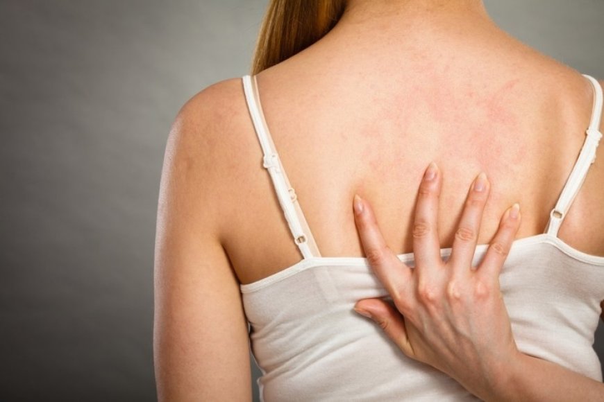 SUS passa a oferecer tratamento integral para dermatite atópica