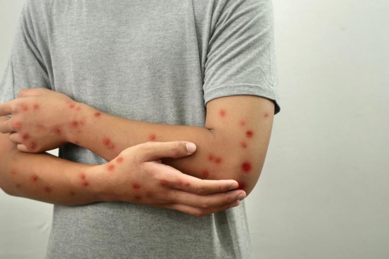 Emergência global por mpox: OMS não aconselha lockdown